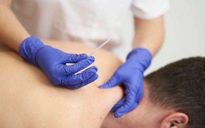 9 Reasons Athletes Trust Motion RX’s Dry Needling Therapy to Recover Faster